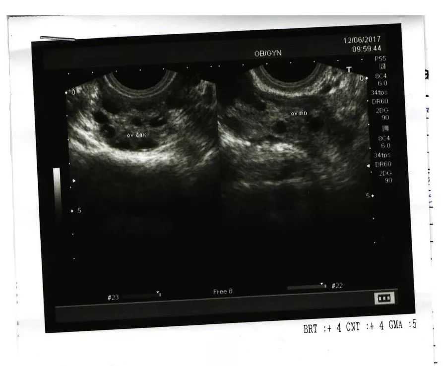 B超显示卵巢多囊，就是得了多囊卵巢综合征吗？